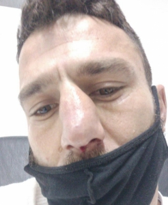 Davi Eliasquevici quebrou o nariz (Foto: Divulgação)