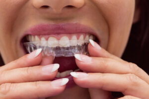 mulher colocando protetor bucal nos dentes