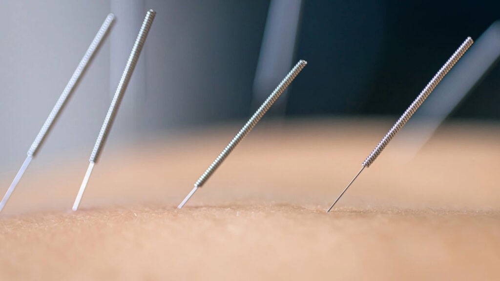 Conheça os benefícios da acupuntura para dores, estresse e saúde geral